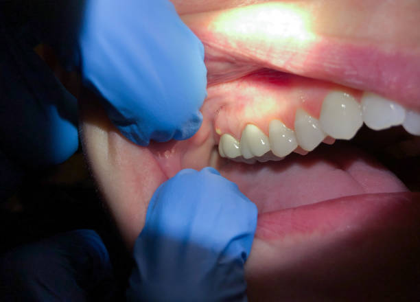 Best Emergency Treatment for Oral Infections in Mount Ephraim, NJ