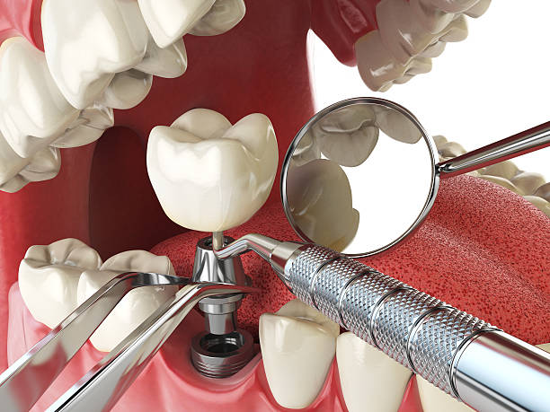 Best Knocked-Out Tooth (Avulsed Tooth) Treatment in Mount Ephraim, NJ
